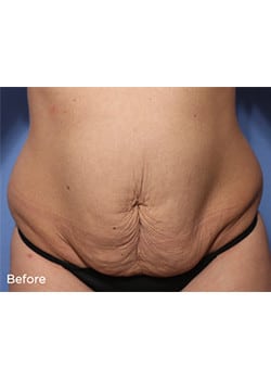 Tummy Tuck