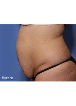Tummy Tuck