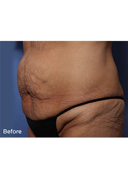 Before Image: Tummy Tuck - left-front-oblique