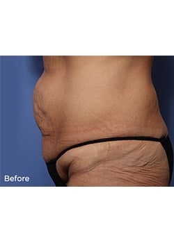 Before Image: Tummy Tuck - other