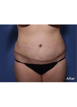 Tummy Tuck