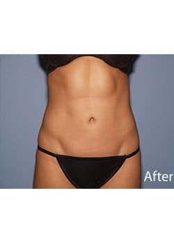 Liposuction