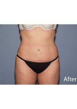 After Image: Liposuction - front