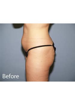 Before Image: Liposuction - other