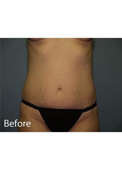 Liposuction
