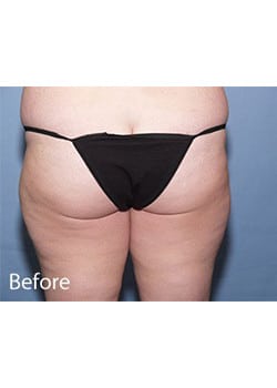 Liposuction