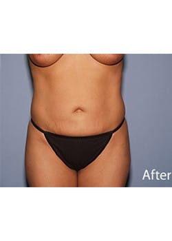 After Image: Liposuction - front