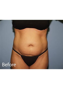 Before Image: Liposuction - front