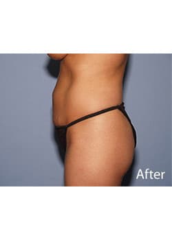 Liposuction