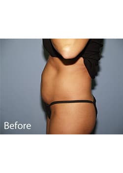 Liposuction