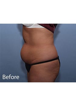 Liposuction