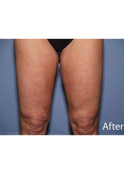 Liposuction