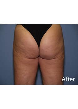 After Image: Liposuction - front