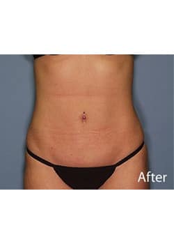After Image: Liposuction - front