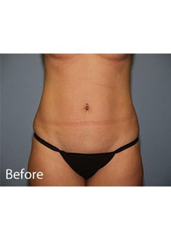 Before Image: Liposuction - front