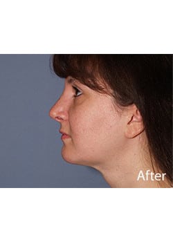 Liposuction