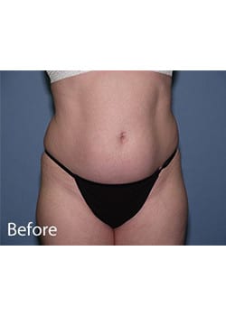 Liposuction