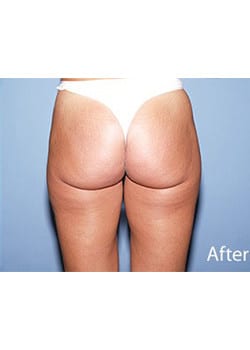 After Image: Liposuction - back