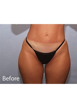 Before Image: Liposuction - front