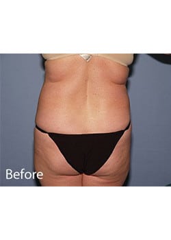 Liposuction