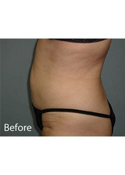 Liposuction