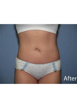 After Image: Liposuction - front