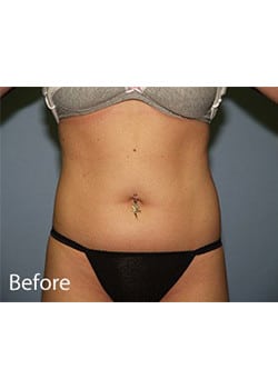 Before Image: Liposuction - front