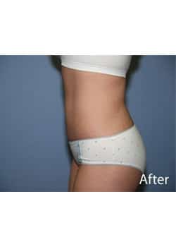 Liposuction