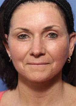 After Image: Laser Resurfacing - front
