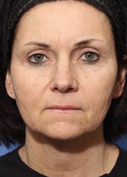 Laser Resurfacing