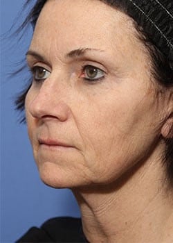 Before Image: Laser Resurfacing - left-front-oblique