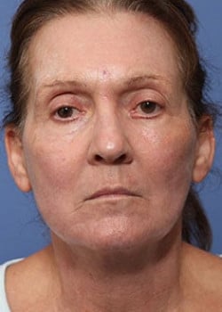 After Image: Laser Resurfacing - front