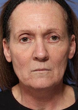 Before Image: Laser Resurfacing - front