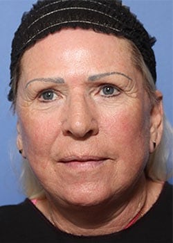 After Image: Laser Resurfacing - front