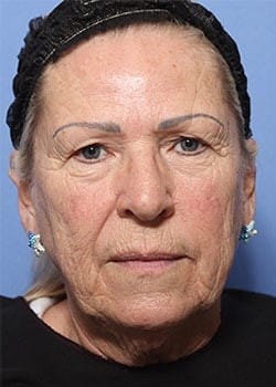 Before Image: Laser Resurfacing - front