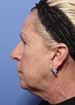 Laser Resurfacing