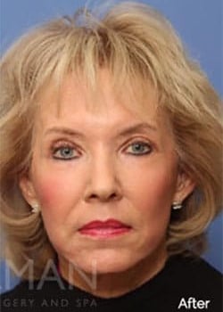 After Image: Laser Resurfacing - front