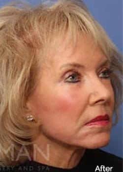 After Image: Laser Resurfacing - right-front-oblique