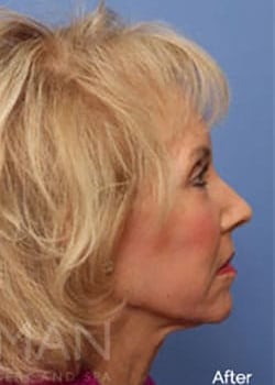 After Image: Laser Resurfacing - other
