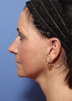 After Image: Profractional - other