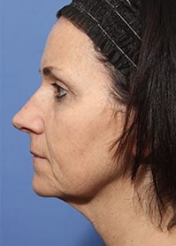 Before Image: Profractional - other