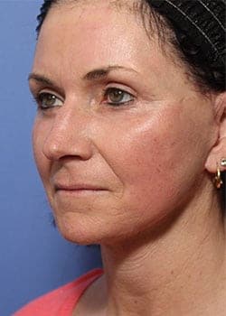 After Image: Profractional - front