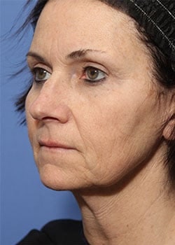 Before Image: Profractional - front
