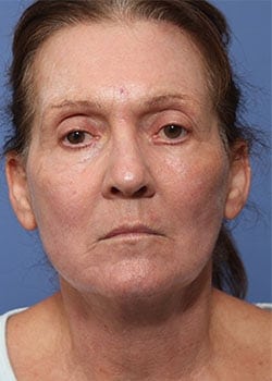 After Image: Profractional - front