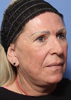 After Image: Profractional - front
