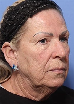Before Image: Profractional - front