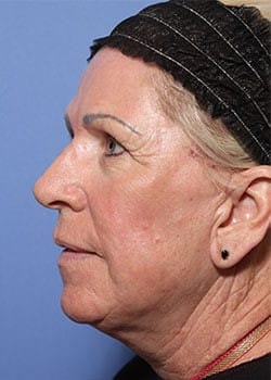 After Image: Profractional - other