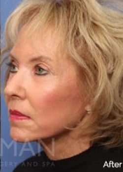 After Image: Profractional - left-front-oblique