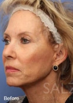 Before Image: Profractional - left-front-oblique