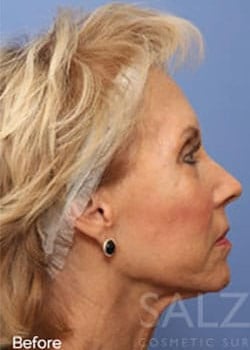 Before Image: Profractional - other